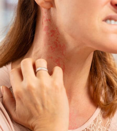 Allergy