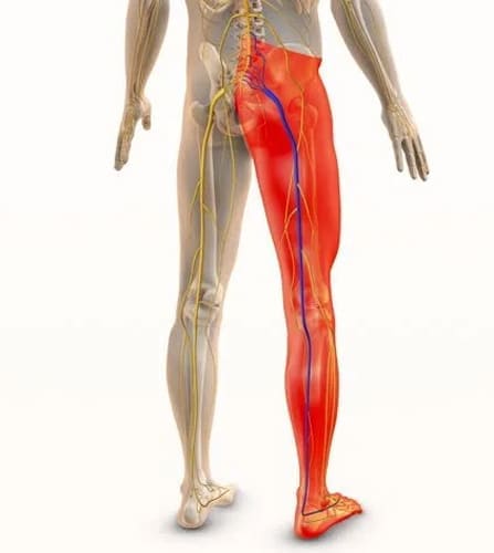 Sciatica