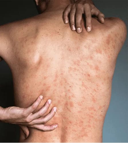 Skin Problems