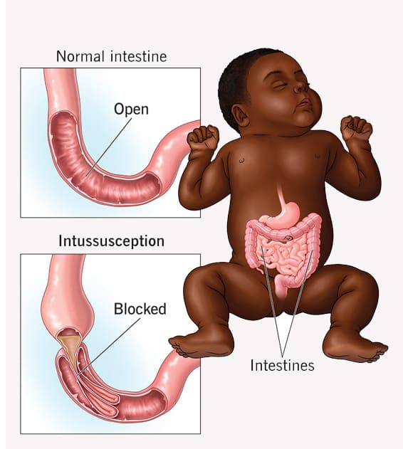 Gastro Intestinal Surgery