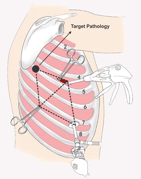 Thoracic Surgeries